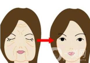 拉皮除皺能堅(jiān)持幾年？與哪些因素有關(guān)？