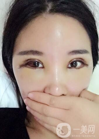 全開(kāi)雙眼皮和開(kāi)眼角