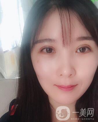 全開(kāi)雙眼皮和開(kāi)眼角