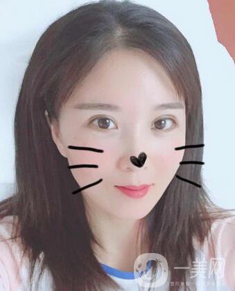 全開(kāi)雙眼皮和開(kāi)眼角