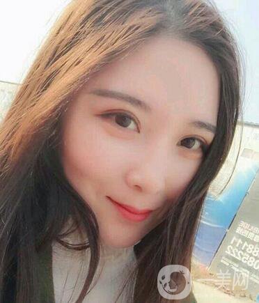 全開(kāi)雙眼皮和開(kāi)眼角