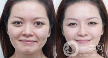 拉皮能維持多久？拉皮的價格是多少