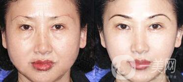 拉皮能維持多久？拉皮的價格是多少