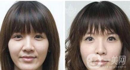 自體脂肪去法令紋*果怎么樣