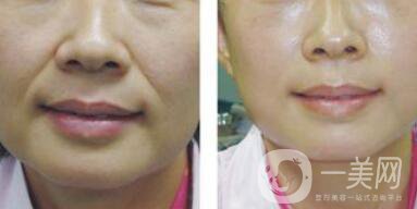 自體脂肪去法令紋*果怎么樣