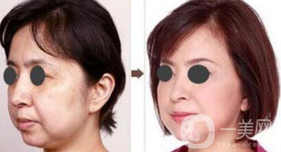 熱瑪吉副作用有哪些 如何避免副作用