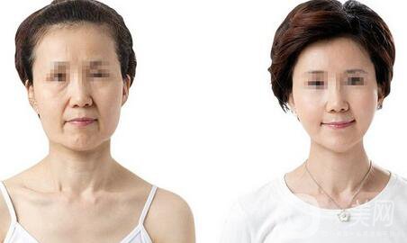 熱瑪吉副作用有哪些 如何避免副作用