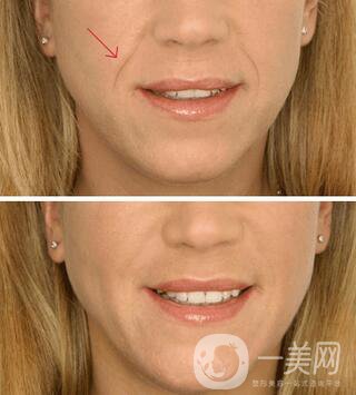 上海自體脂肪填充法令紋多少錢？