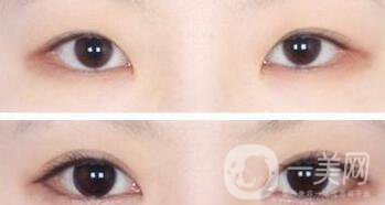 韓式開眼角哪*果好?韓式開眼角醫(yī)院信息介紹