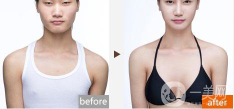 做假體豐胸手術影響生育嗎