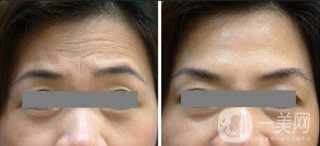 西安熱瑪吉除皺一次多少錢