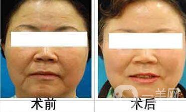 江蘇微波拉皮價格是多少