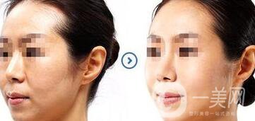 江蘇微波拉皮價格是多少