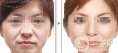 江蘇微波拉皮價格是多少