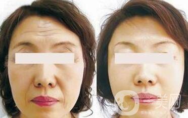 電波拉皮*果怎么樣呢？?jī)r(jià)格高嗎