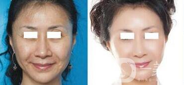 電波拉皮*果怎么樣呢？?jī)r(jià)格高嗎