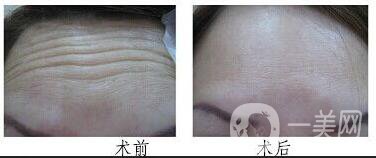 廣東祛抬頭紋多少錢,祛抬頭紋注意事項