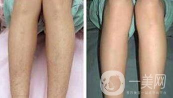 絕緣微針脫毛有用嗎