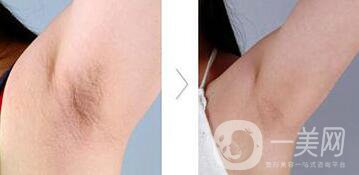 絕緣微針脫毛有用嗎