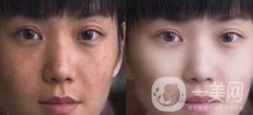 果酸換膚好嗎？果酸換膚有副作用嗎