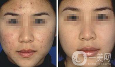 果酸換膚好嗎？果酸換膚有副作用嗎