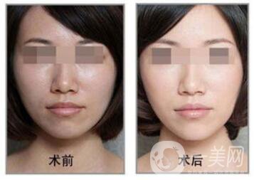 果酸換膚好嗎？果酸換膚有副作用嗎