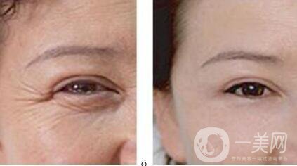 上海電波拉皮做一次大概多少錢