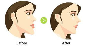 廣東矯正天包地牙價(jià)格大概是多少