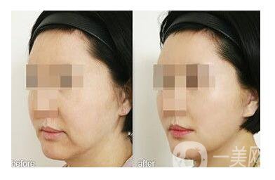 做熱瑪吉多少錢(qián) 熱瑪吉美膚價(jià)格貴不貴