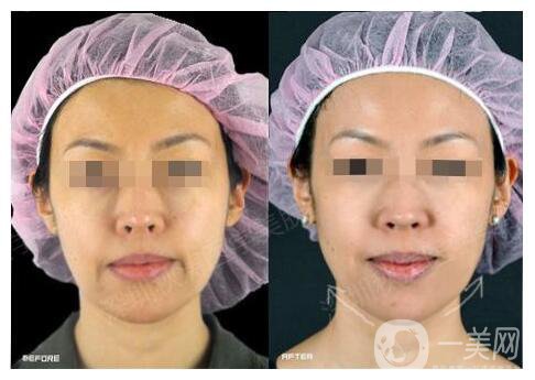 深圳臉部電波拉皮價(jià)格 費(fèi)用需要多少錢