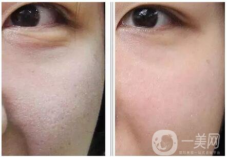 玻尿酸去魚尾紋價格 去魚尾紋費(fèi)用多少錢