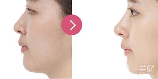 廣東自體脂肪隆鼻價(jià)格,自體脂肪隆鼻注意事項(xiàng)