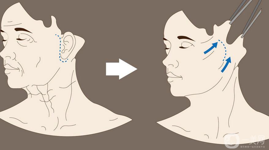 拉皮手術(shù),拉皮手術(shù)術(shù)后護(hù)理