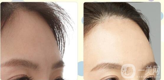 額頭填充術(shù),廣東額頭填充術(shù)多少錢