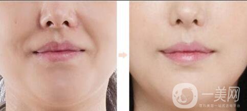 北京去法令紋多少錢