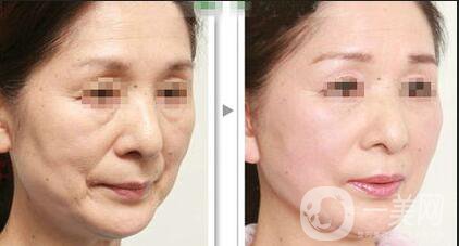 熱瑪吉緊膚價格