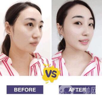 溶脂減肥的危害主要有哪些？詳細介紹