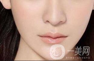 玻尿酸墊下巴,玻尿酸墊下巴注意事項