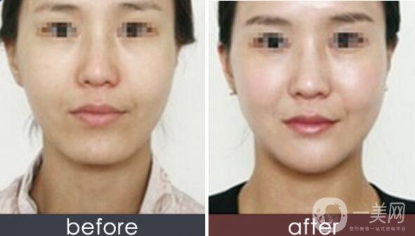 玻尿酸墊下巴,玻尿酸墊下巴注意事項