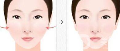 顴骨內(nèi)推*果維持時(shí)間,顴骨內(nèi)推術(shù)后護(hù)理方式