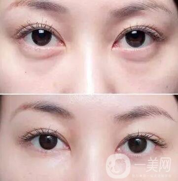 玻尿酸填充淚溝注意事項(xiàng)