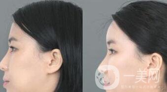 北京自體脂肪豐額頭價(jià)格