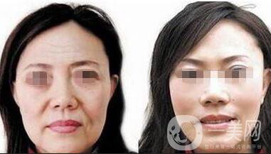 熱瑪吉緊膚除皺術(shù)后護理