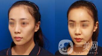 深圳臉部自體脂肪填充價格