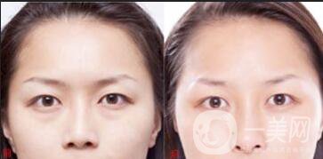 玻尿酸填充淚溝