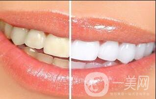 牙齒冷光美白*果,牙齒冷光美白*果保持多久