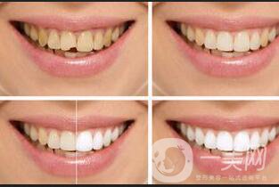 牙齒冷光美白*果