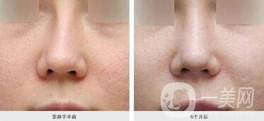 廣東歪鼻矯正手術(shù)費(fèi)用,歪鼻矯正手術(shù)費(fèi)用,歪鼻矯正手術(shù)