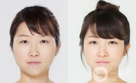 深圳雙下巴吸脂價(jià)格