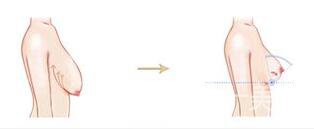 上?？s乳手術(shù)多少錢(qián),縮乳手術(shù)多少錢(qián)